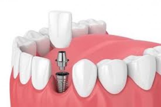 DENTAL İMPLANT MALZEMESİ SATIN ALINACAKTIR