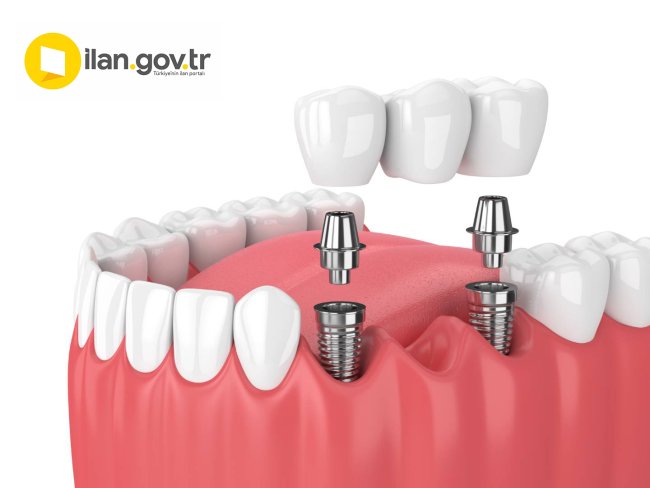 İMPLANT SATIN ALINACAKTIR
